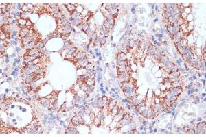 Immunohistochemistry of paraffin-embedded Human colon carcinoma using HIGD1A Polyclonal Antibody at dilution of 1:100 (40x lens). (HIGD1A antibody)
