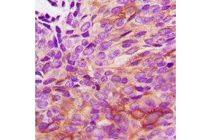 Immunohistochemical analysis of HSPB2 staining in human renal cancer formalin fixed paraffin embedded tissue section. (HSPB2 antibody  (C-Term))