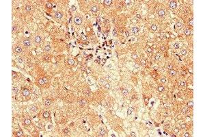 Immunohistochemistry of paraffin-embedded human liver cancer using ABIN7147128 at dilution of 1:100 (CD177 antibody  (AA 22-321))