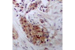Immunohistochemical analysis of STAT4 staining in human breast cancer formalin fixed paraffin embedded tissue section. (STAT4 antibody  (C-Term))