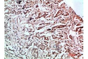 Immunohistochemical analysis of paraffin-embedded human-stomach-cancer, antibody was diluted at 1:200