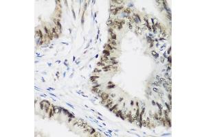 Immunohistochemistry of paraffin-embedded human colon carcinoma using  antibody (ABIN6131366, ABIN6136608, ABIN6136609 and ABIN6223268) at dilution of 1:200 (40x lens).