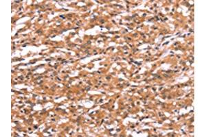 The image on the left is immunohistochemistry of paraffin-embedded Human thyroid cancer tissue using ABIN7190731(GABRA1 Antibody) at dilution 1/30, on the right is treated with synthetic peptide. (GABRA1 antibody)