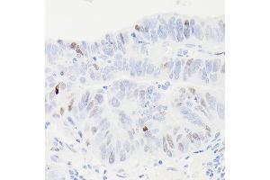 Immunohistochemistry of paraffin-embedded human colon carcinoma using [KO Validated] p53 Rabbit mAb (ABIN7271080) at dilution of 1:100 (40x lens). (p53 antibody)