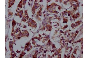 IHC image of ABIN7127491 diluted at 1:100 and staining in paraffin-embedded human breast cancer performed on a Leica BondTM system. (Recombinant FGFR4 antibody)