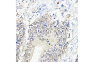 Immunohistochemistry of paraffin-embedded human colon carcinoma using GPX2 antibody (ABIN7267435) at dilution of 1:100 (40x lens). (Glutathione Peroxidase 2 antibody  (AA 100-180))