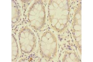 Immunohistochemistry of paraffin-embedded human colon cancer using ABIN7176692 at dilution of 1:100 (SLC39A7 antibody  (AA 235-380))