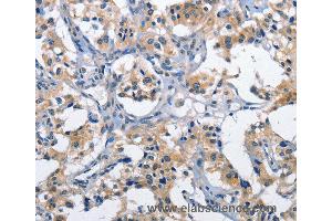 Immunohistochemistry of Human thyroid cancer using CLEC2D Polyclonal Antibody at dilution of 1:60 (CLEC2D antibody)
