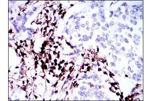 Immunohistochemical analysis of paraffin-embedded breast cancer tissues using PTPRC mouse mAb with DAB staining. (CD45 antibody  (AA 928-989))