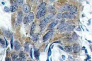 Immunohistochemistry (IHC) analyzes of p-Catenin-beta antibody in paraffin-embedded human colon carcinoma tissue. (CTNNB1 antibody  (pSer33))