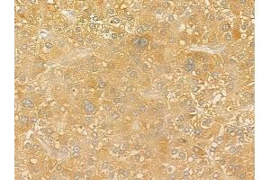 ABIN6258625 and ABIN6275893 at 1/100 staining human hepatocellular carcinoma by IHC-P. (CPA antibody  (Internal Region))