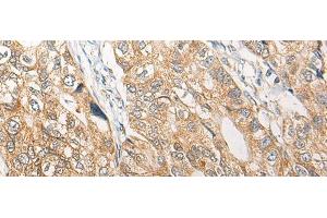 Immunohistochemistry of paraffin-embedded Human gastric cancer tissue using RGN Polyclonal Antibody at dilution of 1:25(x200) (Regucalcin antibody)