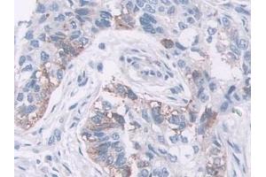 Detection of NELL2 in Human Lung cancer Tissue using Polyclonal Antibody to NEL Like Protein 2 (NELL2)