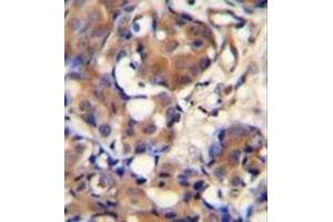 Immunohistochemistry analysis in formalin fixed and paraffin embedded human breast carcinoma reacted with Kininogen-1 Antibody (N-term) followed which was peroxidase conjugated to the secondary antibody and followed by DAB staining. (KNG1 antibody  (N-Term))