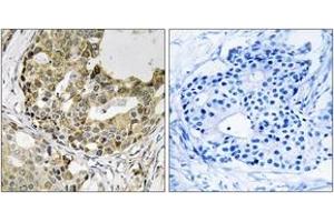 Immunohistochemistry analysis of paraffin-embedded human breast carcinoma tissue, using NXPH1 Antibody. (Neurexophilin 1 antibody  (AA 77-126))