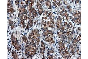 Immunohistochemical staining of paraffin-embedded Carcinoma of liver tissue using anti-PSMC3 mouse monoclonal antibody. (PSMC3 antibody)