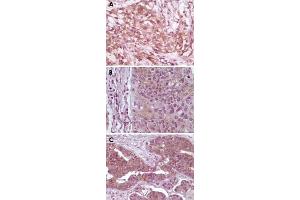 Immunohistochemical analysis of paraffin-embedded human pancreas carcinoma (A), esophagus carcinoma tissue (B) and ovary tumor tissue, showing cytoplasmic and membrane localization using EIF4EBP1 monoclonal antibody, clone 11G12C11  with DAB staining. (eIF4EBP1 antibody)