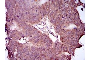 Immunohistochemical analysis of paraffin-embedded rectum cancer tissues using EGFR mutant mouse mAb with DAB staining. (EGFR Mutant (AA 693-893) antibody)