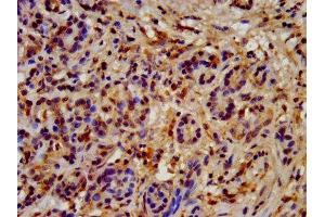IHC image of ABIN7154923 diluted at 1:200 and staining in paraffin-embedded human pancreatic cancer performed on a Leica BondTM system. (HSP9AB1 (AA 150-355) antibody)