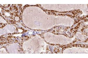 ABIN6267203 at 1/100 staining Human thyroid cancer tissue by IHC-P. (Tuberin antibody  (pSer1387))