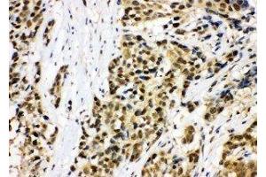 Anti-MCM7 antibody, IHC(P) IHC(P): Human Lung Cancer Tissue (MCM7 antibody  (C-Term))