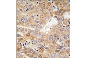 Formalin-fixed and paraffin-embedded human hepatocarcinoma tissue reacted with PGK1 antibody (Center), which was peroxidase-conjugated to the secondary antibody, followed by DAB staining. (PGK1 antibody  (Middle Region))
