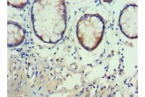 Immunohistochemistry of paraffin-embedded human colon cancer using ABIN7142909 at dilution of 1:100 (AKAP5 antibody  (AA 1-270))