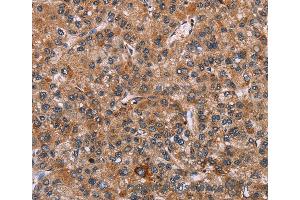 Immunohistochemistry of Human liver cancer using EGR4 Polyclonal Antibody at dilution of 1:20 (EGR4 antibody)