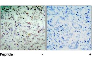 Immunohistochemical analysis of paraffin-embedded human breast carcinoma tissue, using RB1 (phospho S780) polyclonal antibody . (Retinoblastoma 1 antibody  (pSer780))