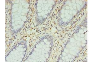 Immunohistochemistry of paraffin-embedded human colon cancer using ABIN7145489 at dilution of 1:100