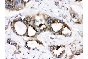 Anti- TMEM173 Picoband antibody, IHC(P) IHC(P): Human Lung Cancer Tissue (STING/TMEM173 antibody  (C-Term))