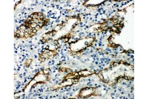 IHC-P: Aquaporin 4 antibody testing of human lung cancer tissue (Aquaporin 4 antibody  (AA 258-27))