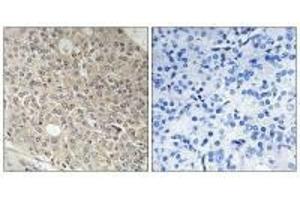 Immunohistochemistry analysis of paraffin-embedded human prostate carcinoma tissue using AMOTL1 antibody. (AMOTL1 antibody)