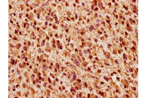 IHC image of ABIN7166287 diluted at 1:200 and staining in paraffin-embedded human glioma performed on a Leica BondTM system. (WIZ antibody  (AA 1469-1574))