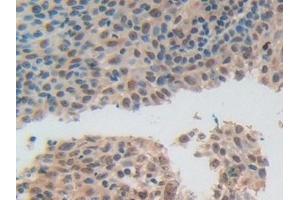 Detection of ADRM1 in Human Skin cancer Tissue using Polyclonal Antibody to Adhesion Regulating Molecule 1 (ADRM1) (ADRM1 antibody  (AA 2-407))