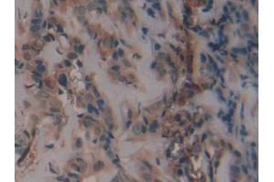 DAB staining on IHC-P; Samples: Human Breast cancer Tissue (PAI1 antibody  (AA 25-402))
