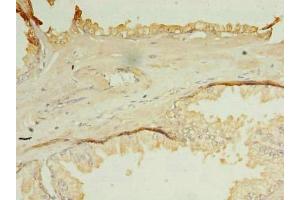 Immunohistochemistry of paraffin-embedded human prostate cancer using ABIN7162127 at dilution of 1:100 (OCIAD1 antibody  (AA 1-245))