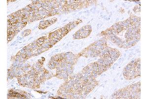 Immunohistochemistry (IHC) image for anti-Receptor tyrosine-protein kinase erbB-2 (ErbB2/Her2) (AA 1205-1255) antibody (ABIN7455181) (Recombinant ErbB2/Her2 antibody  (AA 1205-1255))