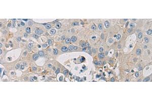 Immunohistochemistry of paraffin-embedded Human breast cancer tissue using WFDC3 Polyclonal Antibody at dilution of 1:40(x200) (WFDC3 antibody)
