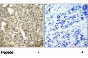 Immunohistochemical analysis of paraffin-embedded human breast carcinoma tissue using PRKCD polyclonal antibody  .