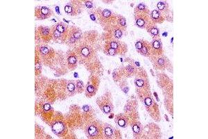 Immunohistochemical analysis of MBTPS1 staining in human liver cancer formalin fixed paraffin embedded tissue section. (MBTPS1 antibody)