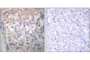 Immunohistochemistry analysis of paraffin-embedded human breast carcinoma, using Fyn (Phospho-Tyr530) Antibody. (FYN antibody  (pTyr531))