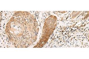Immunohistochemistry of paraffin-embedded Human esophagus cancer tissue using EXD2 Polyclonal Antibody at dilution of 1:55(x200) (EXD2 antibody)