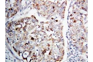 IHC-P: MEK1 antibody testing of human lung cancer tissue (MEK1 antibody  (C-Term))