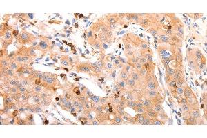 Immunohistochemistry of paraffin-embedded Human lung cancer tissue using CELSR2 Polyclonal Antibody at dilution 1:50 (CELSR2 antibody)