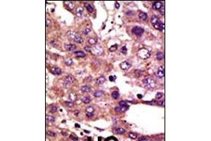 Formalin-fixed and paraffin-embedded human cancer tissue reacted with the primary antibody, which was peroxidase-conjugated to the secondary antibody, followed by DAB staining. (GPI antibody  (AA 571-601))