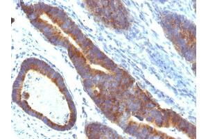 Formalin-fixed, paraffin-embedded human Colon Carcinoma stained with MUC3 Monoclonal Antibody (MUC3/1154).