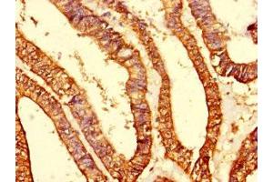Immunohistochemistry of paraffin-embedded human endometrial cancer using ABIN7142242 at dilution of 1:100 (Putative Mitochondrial Ribosomal Protein S1 (MRPS1) (AA 1-201) antibody)