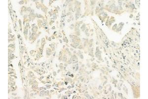 ABIN6261918 and ABIN6278469 at 1/100 staining human lung squamous cell carcinoma by IHC-P. (GUCY1B2 antibody  (C-Term))
