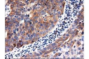 Immunohistochemical staining of paraffin-embedded Carcinoma of Human kidney tissue using anti-ALDH1L1 mouse monoclonal antibody. (ALDH1L1 antibody)